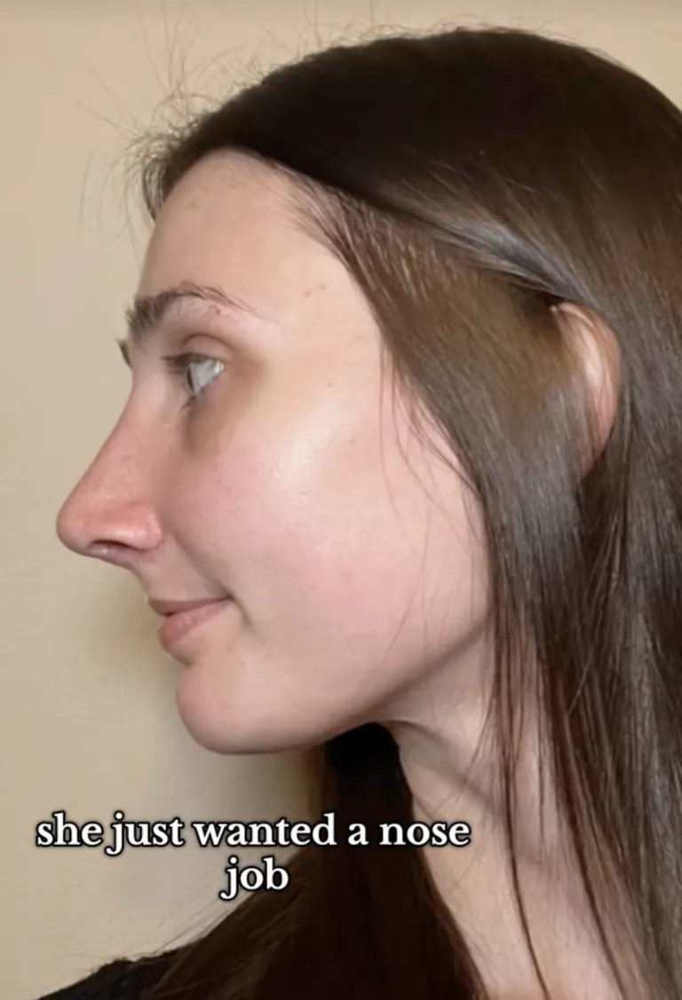 Devyn Aiken shows a side profile before her rhinoplasty, part of her pre-surgery documentation. | Source: Tiktok/doseofdevy
